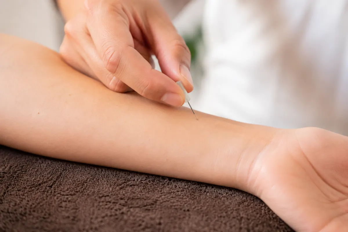 La nutripuncture, c'est quoi et est-ce vraiment fait pour toi ? La nutripuncture, c'est quoi exactement ?